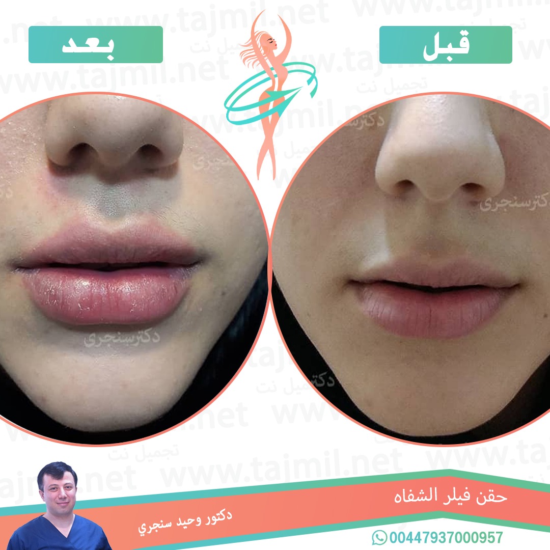  - دکتور وحید سنجري عملية حقن فیلر الشفاه في ايران مع تجميل نت