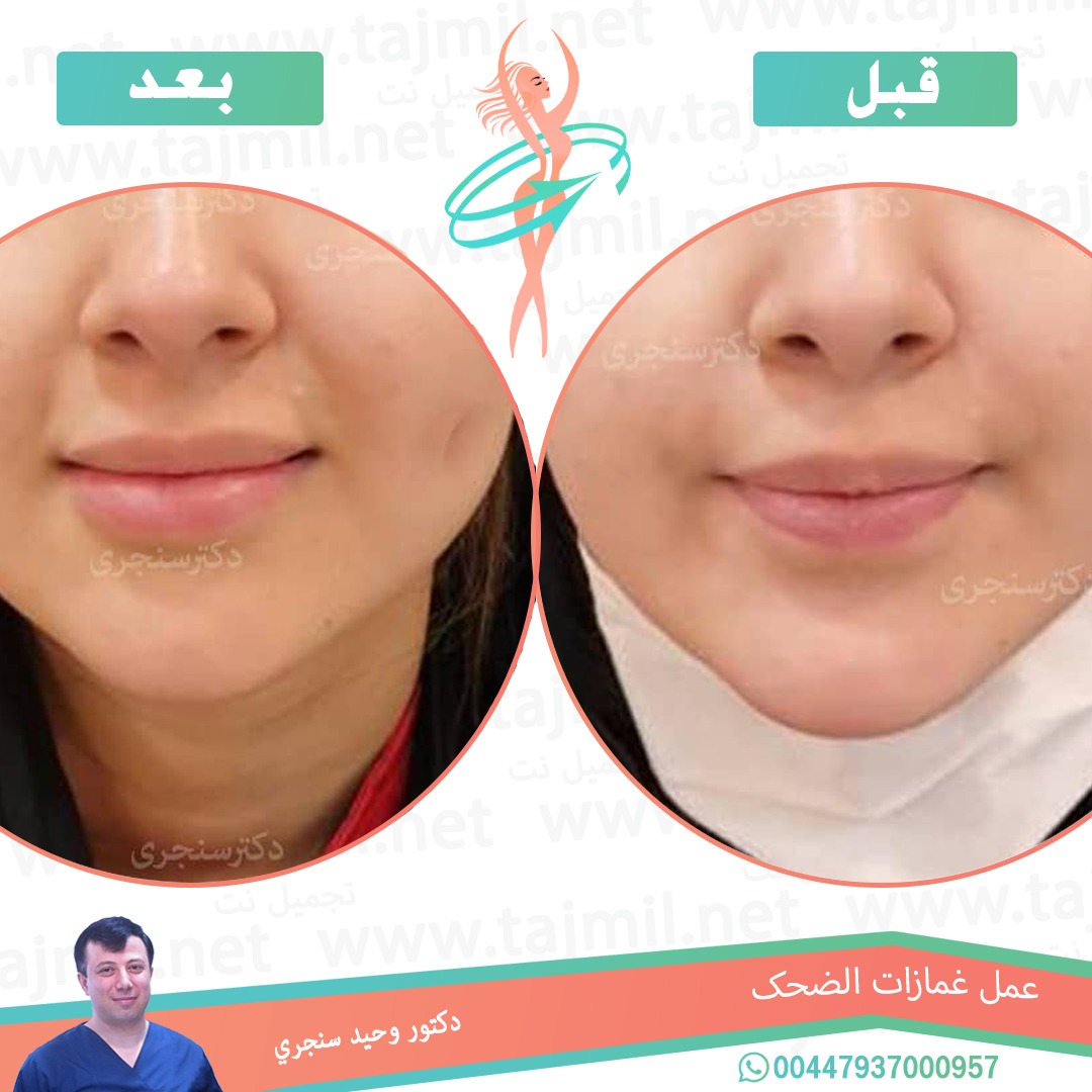  - دکتور وحید سنجري عملية غمازات الضحک في ايران مع تجميل نت