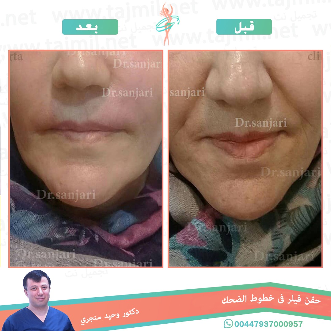  - دکتور وحید سنجري عملية حقن فیلر في لخطوط الضحک في ايران مع تجميل نت