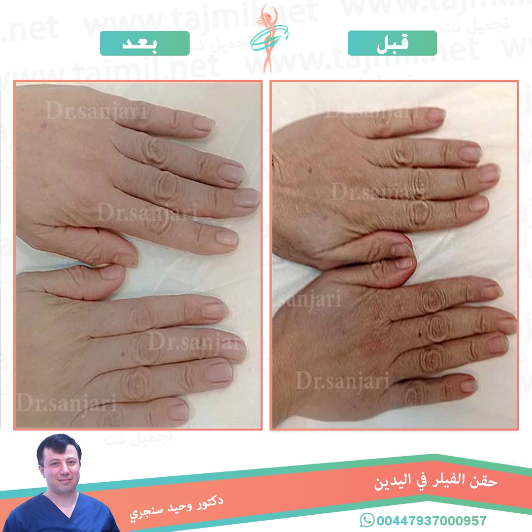  - دکتور وحید سنجري عملية حقن الفیلر في  الیدین  في ايران مع تجميل نت