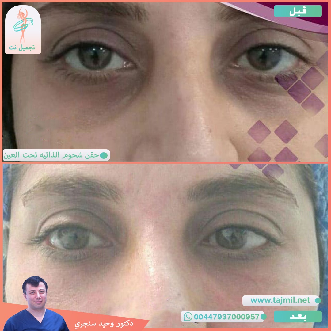  - دکتور وحید سنجري عملية حقن شحوم الذاتیه تحت العین في ايران مع تجميل نت