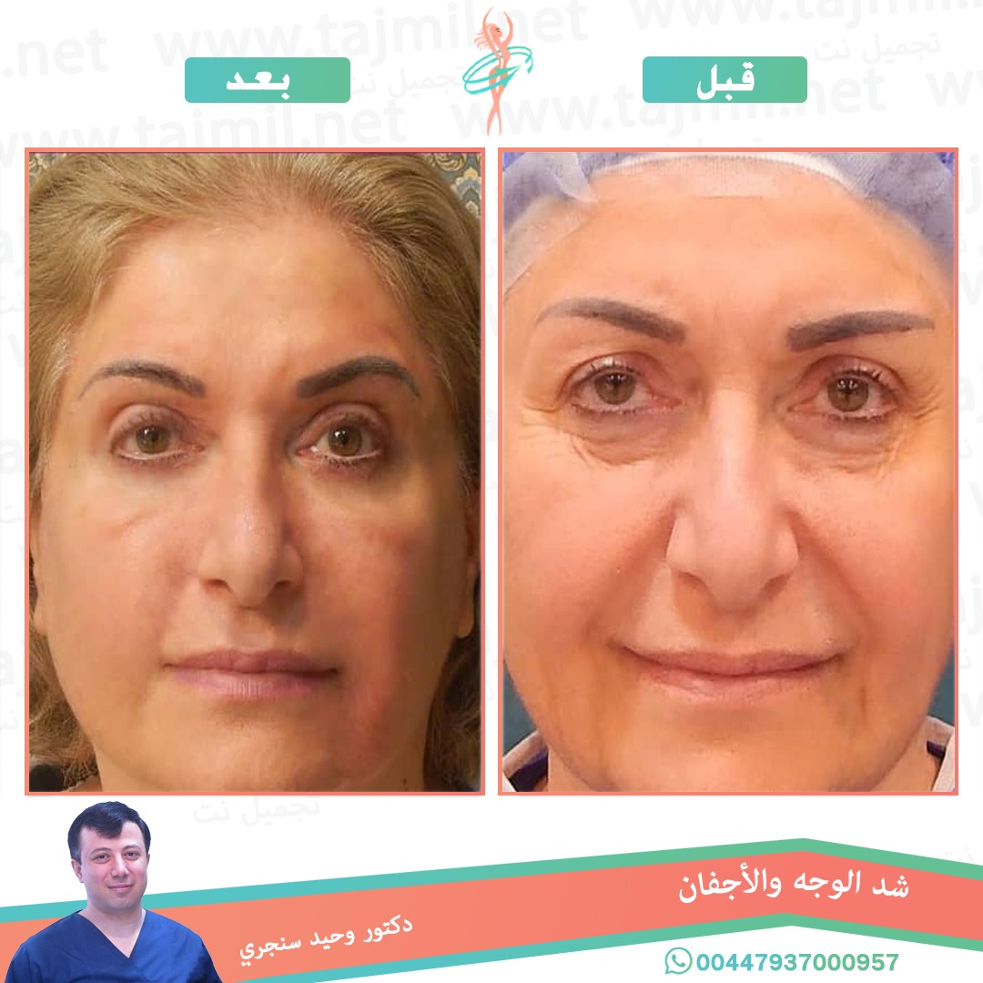  - دکتور وحید سنجري عملية شد الوجه و الأجفان في ايران مع تجميل نت