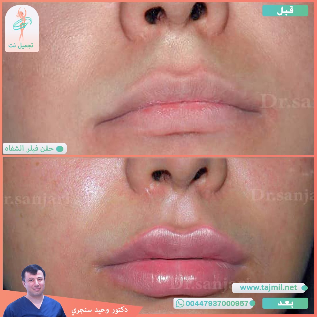  - دکتور وحید سنجري عملية حقن فیلر الشفاه في ايران مع تجميل نت