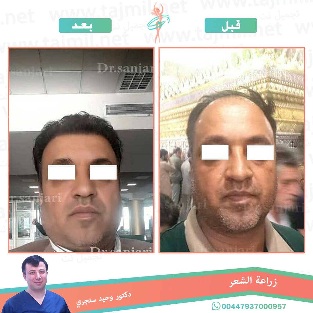  - دکتور وحید سنجري عملية زراعة العشر في ايران مع تجميل نت