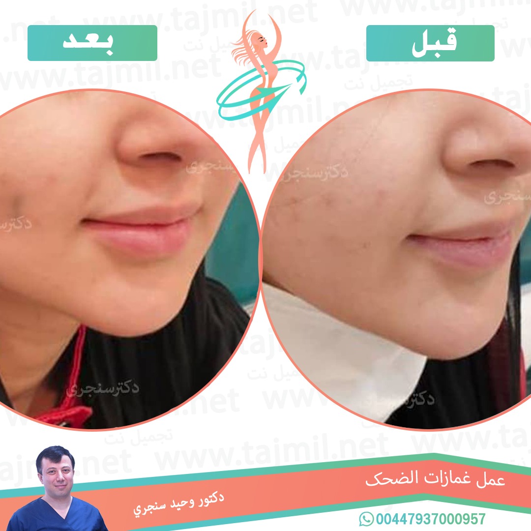  - دکتور وحید سنجري عملية غمازات الضحک في ايران مع تجميل نت