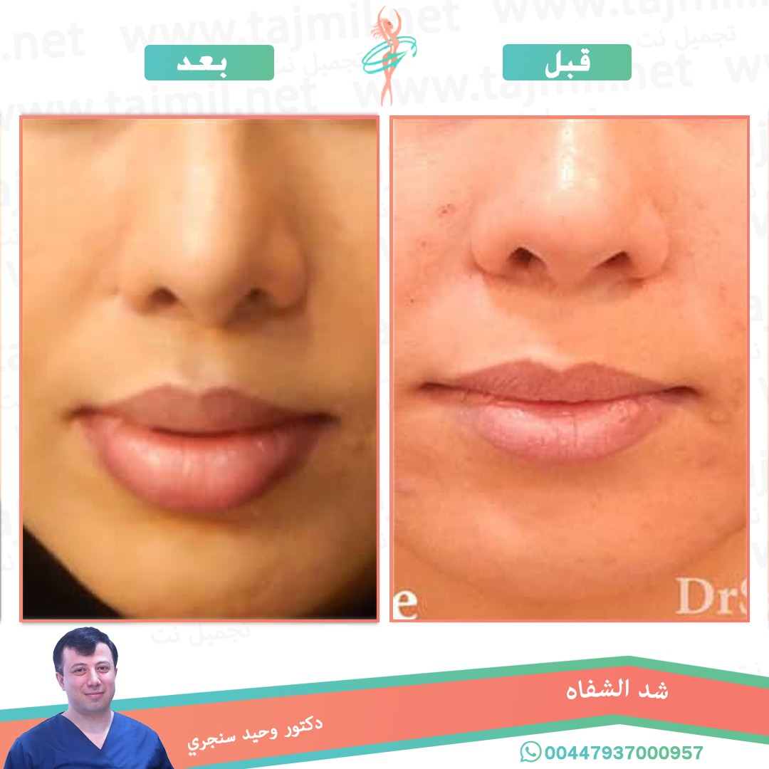  - دکتور وحید سنجري عملية شد الشفاه في ايران مع تجميل نت