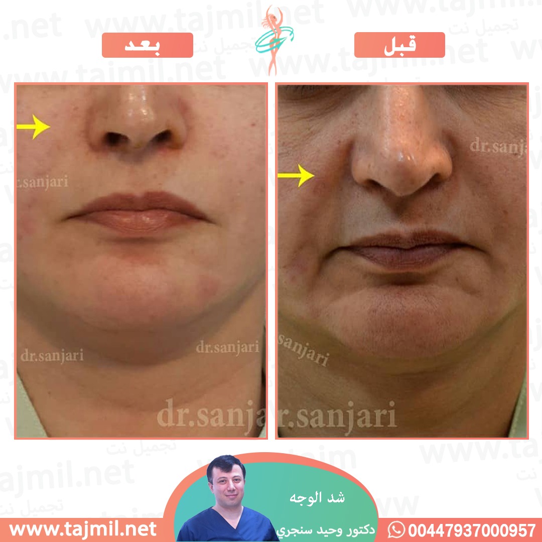  - دکتور وحید سنجري عملية شد الوجه في ايران مع تجميل نت