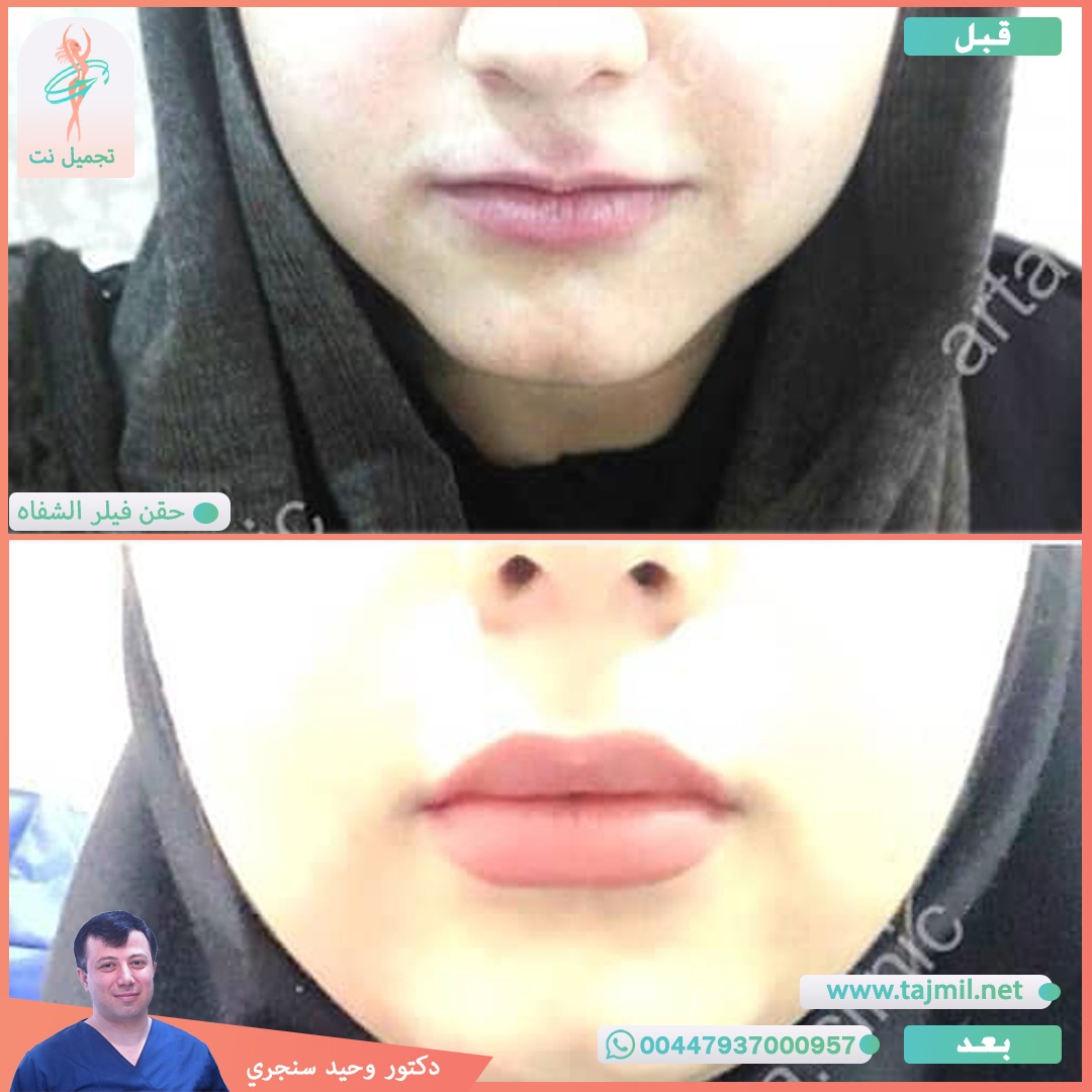  - دکتور وحید سنجري عملية حقن فیلر الشفاه في ايران مع تجميل نت