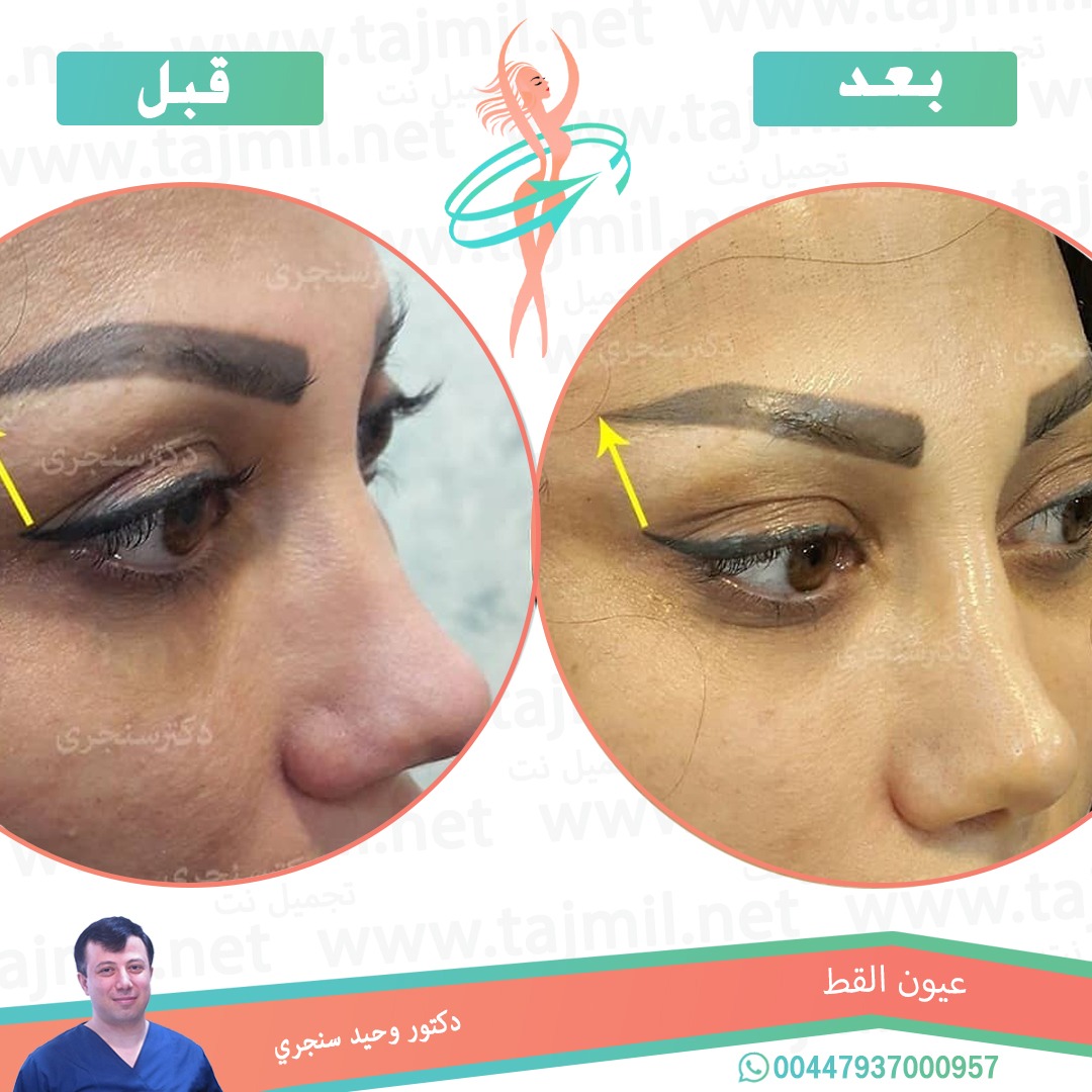  - دکتور وحید سنجري عملية عیون القط  في ايران مع تجميل نت