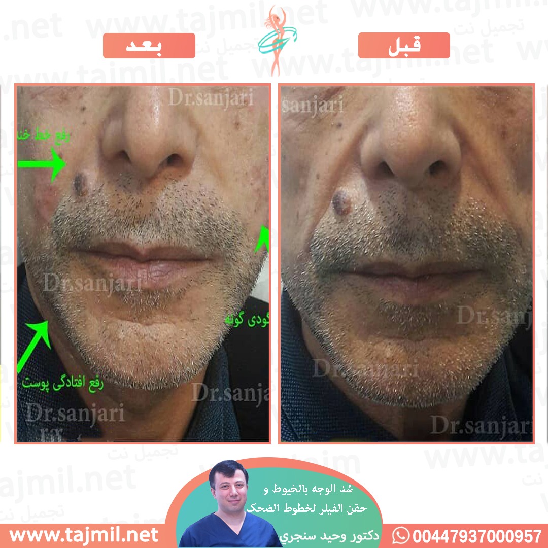  - دکتور وحید سنجري عملية شد الوجه بالخیوط و حقن الفیلر لخطوط الضحک  في ايران مع تجميل نت