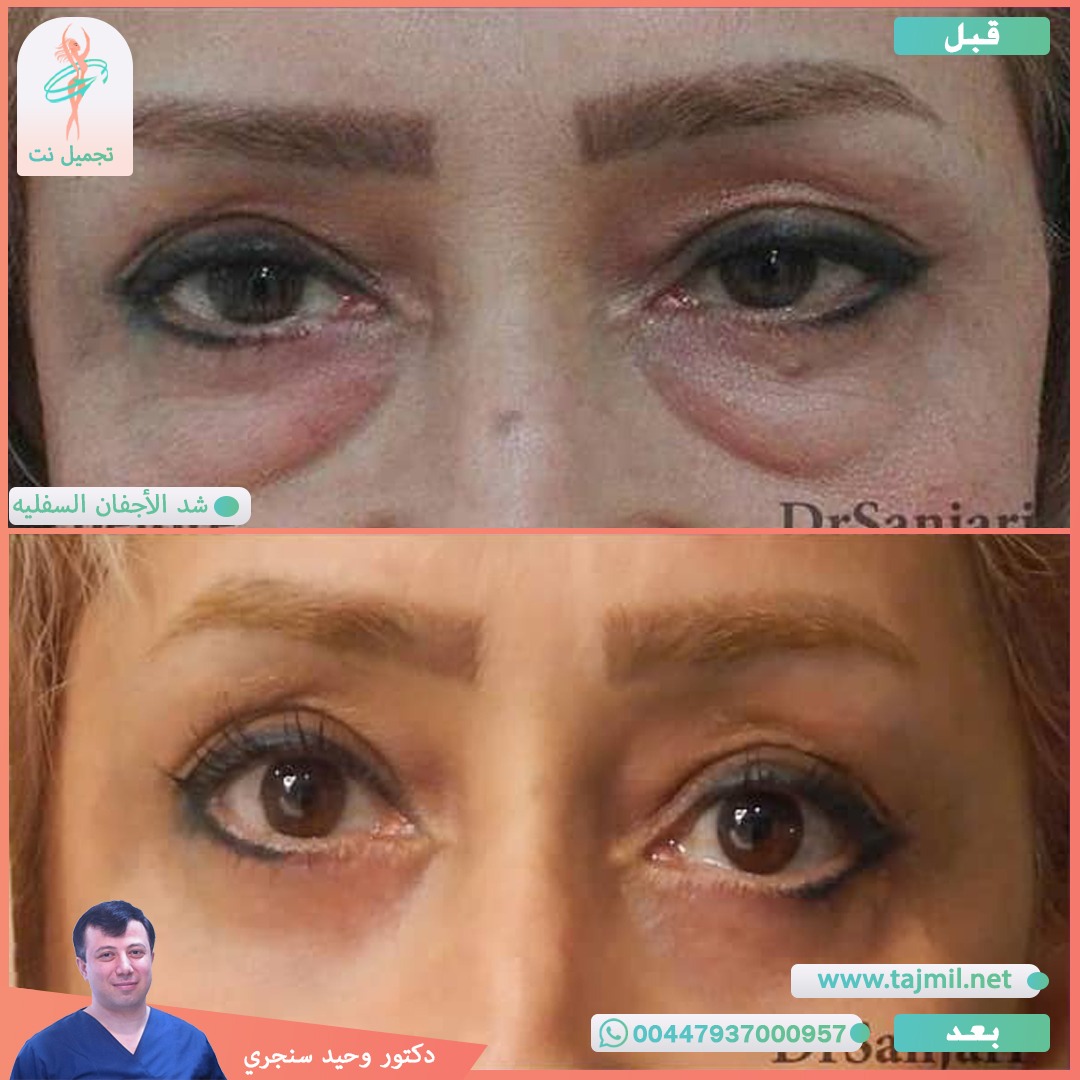  - دکتور وحید سنجري عملية شد الأجفان السفیه  في ايران مع تجميل نت