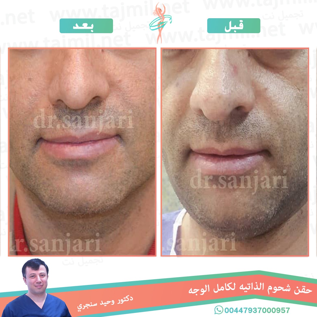  - دکتور وحید سنجري عملية حقن الشحوم الذاتیه لکامل الوجه في ايران مع تجميل نت