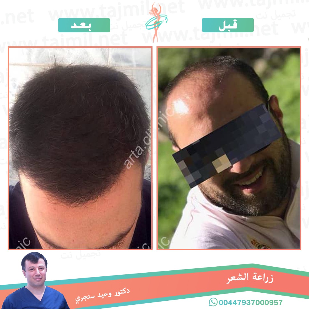  - دکتور وحید سنجري عملية زراعة العشر في ايران مع تجميل نت