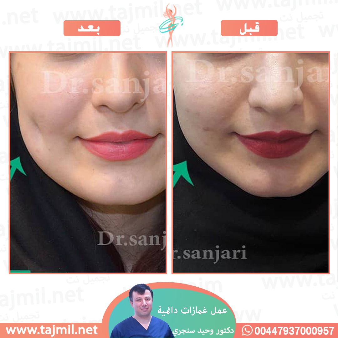  - دکتور وحید سنجري عملية غمازات دائمیة في ايران مع تجميل نت