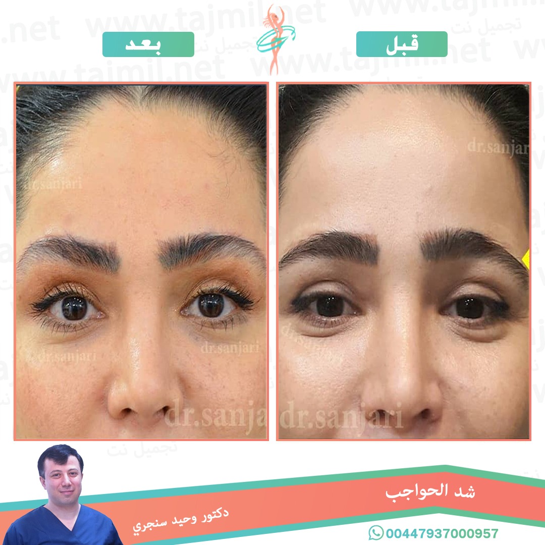  - دکتور وحید سنجري عملية شد الحواجب في ايران مع تجميل نت