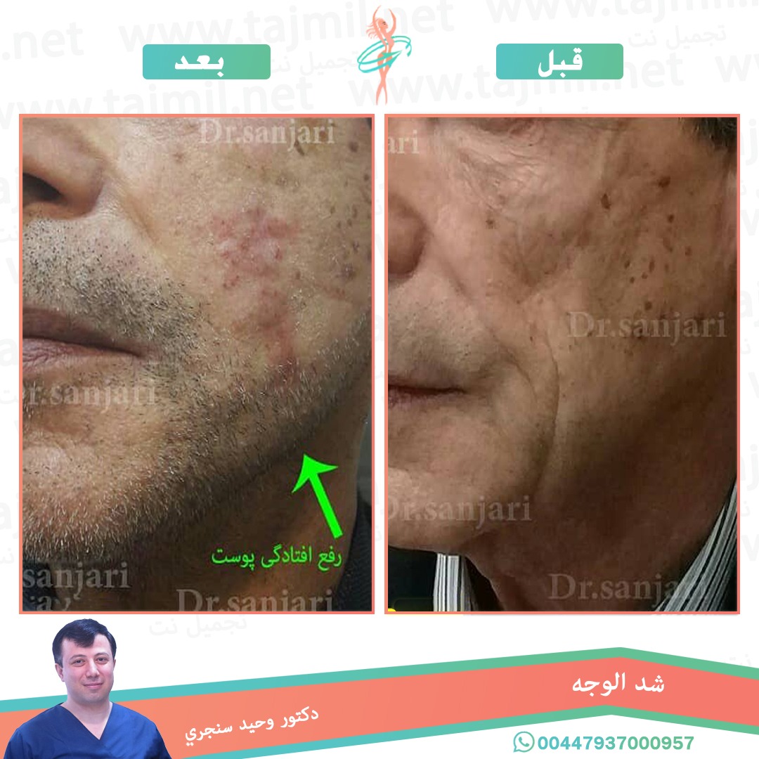  - دکتور وحید سنجري عملية شد الوجه في ايران مع تجميل نت