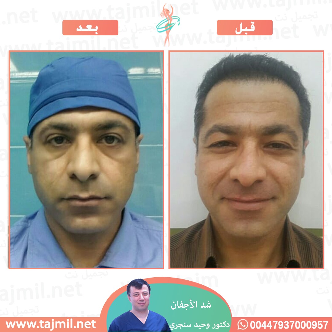  - دکتور وحید سنجري عملية زراعة العشر في ايران مع تجميل نت