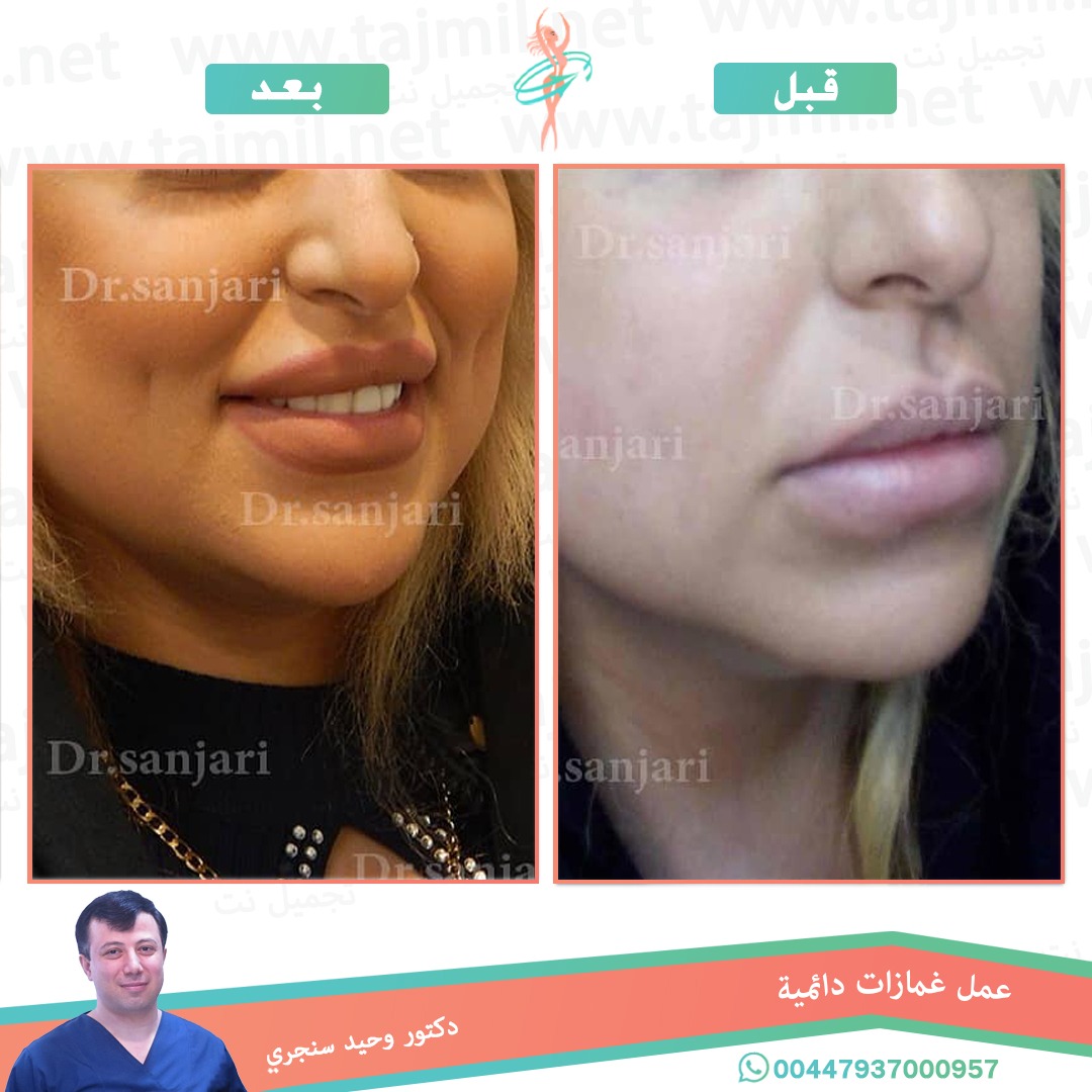  - دکتور وحید سنجري عملية غمازات دائمیة في ايران مع تجميل نت