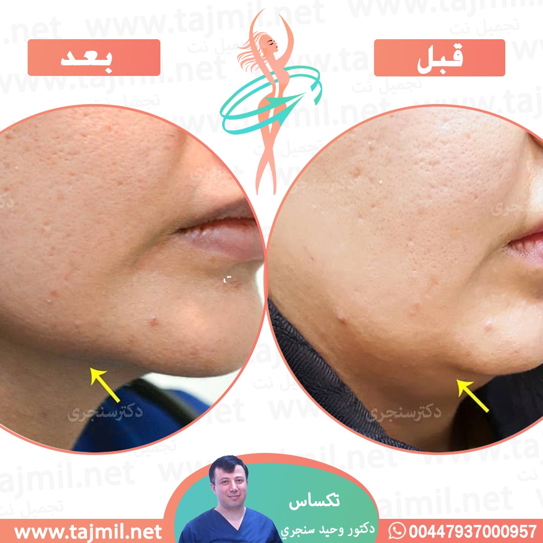  - دکتور وحید سنجري عملية تکساس في ايران مع تجميل نت