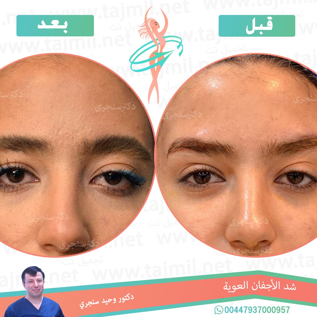  - دکتور وحید سنجري عملية شد الأجفان العویة في ايران مع تجميل نت