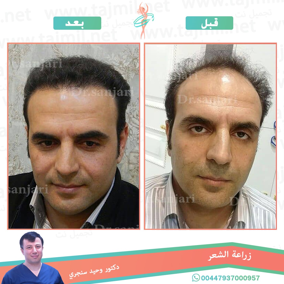  - دکتور وحید سنجري عملية زراعة العشر في ايران مع تجميل نت