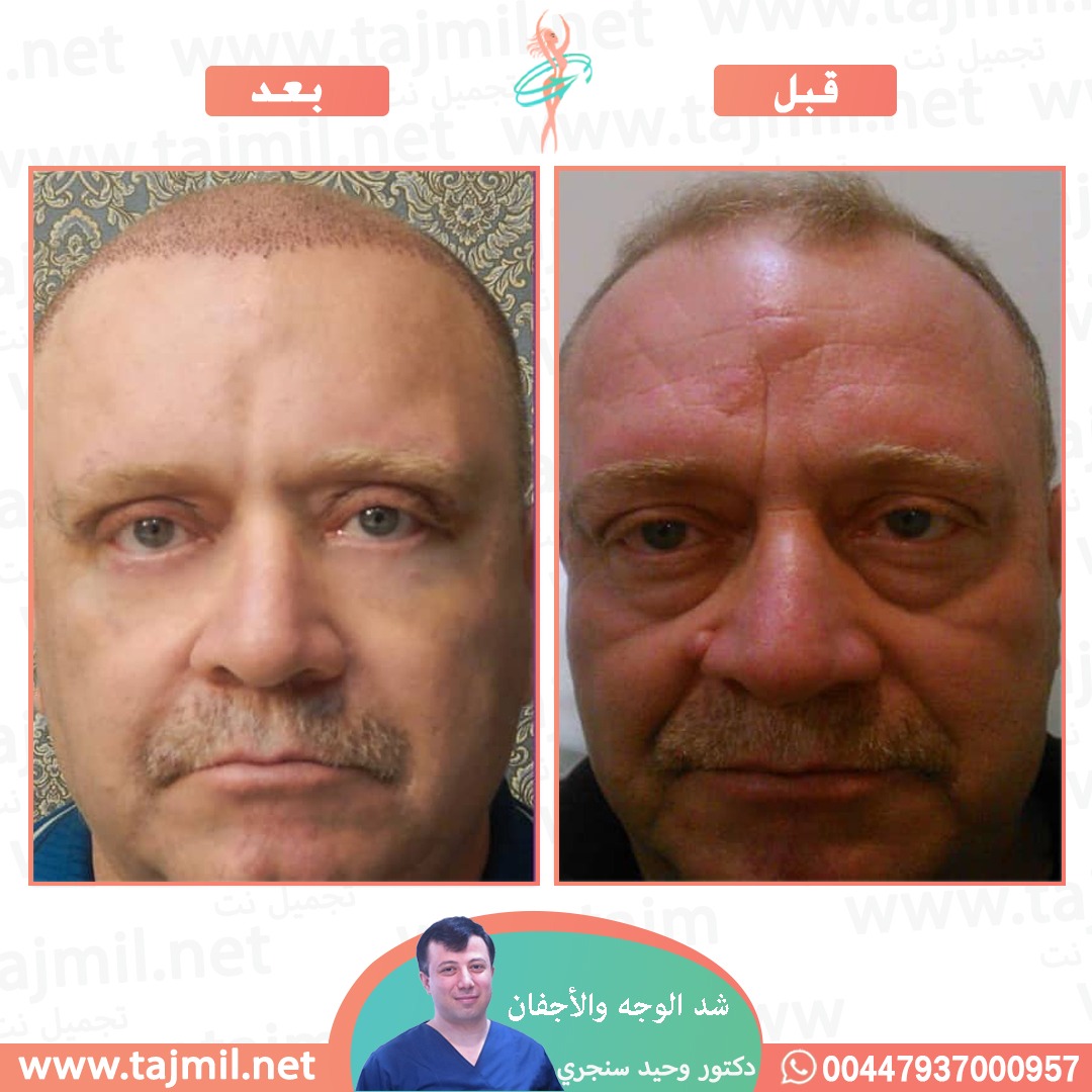  - دکتور وحید سنجري عملية زراعة العشر في ايران مع تجميل نت