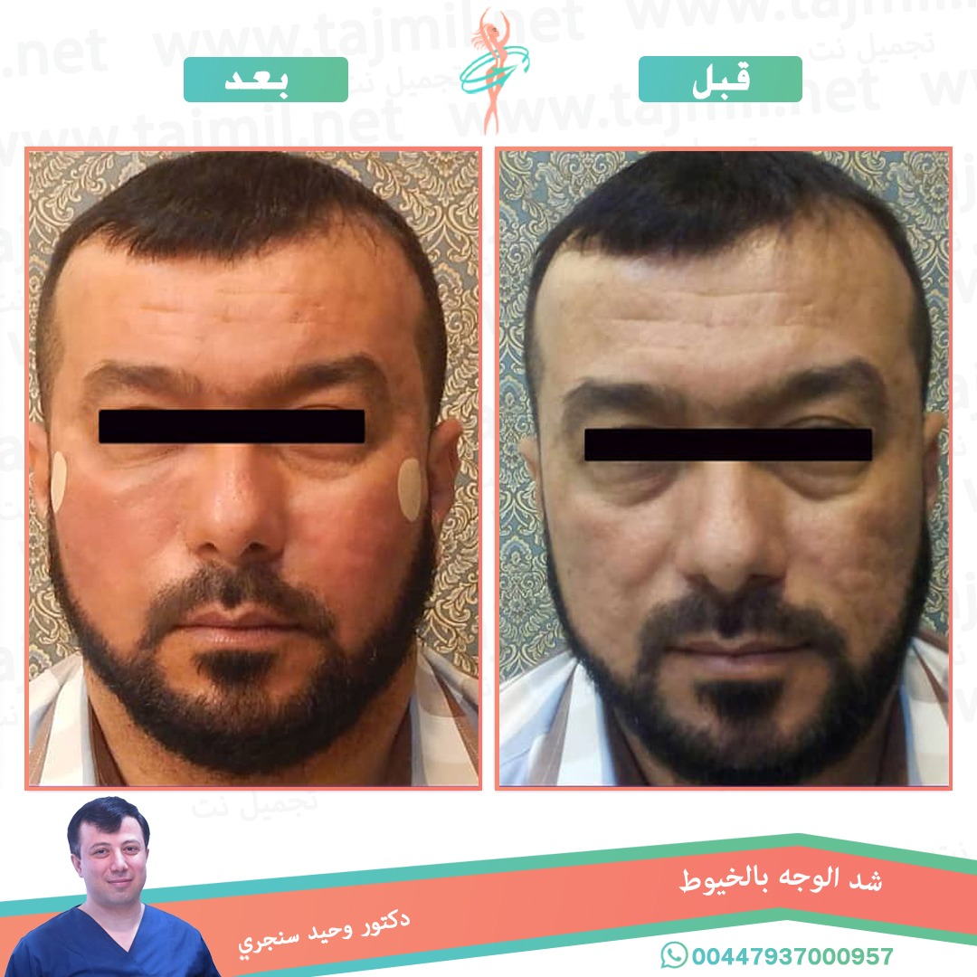  - دکتور وحید سنجري عملية زراعة العشر في ايران مع تجميل نت