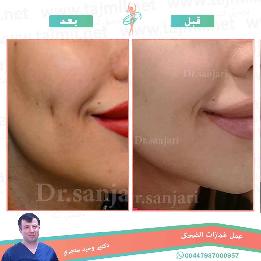  - دکتور وحید سنجري عملية غمازات الضحک في ايران مع تجميل نت