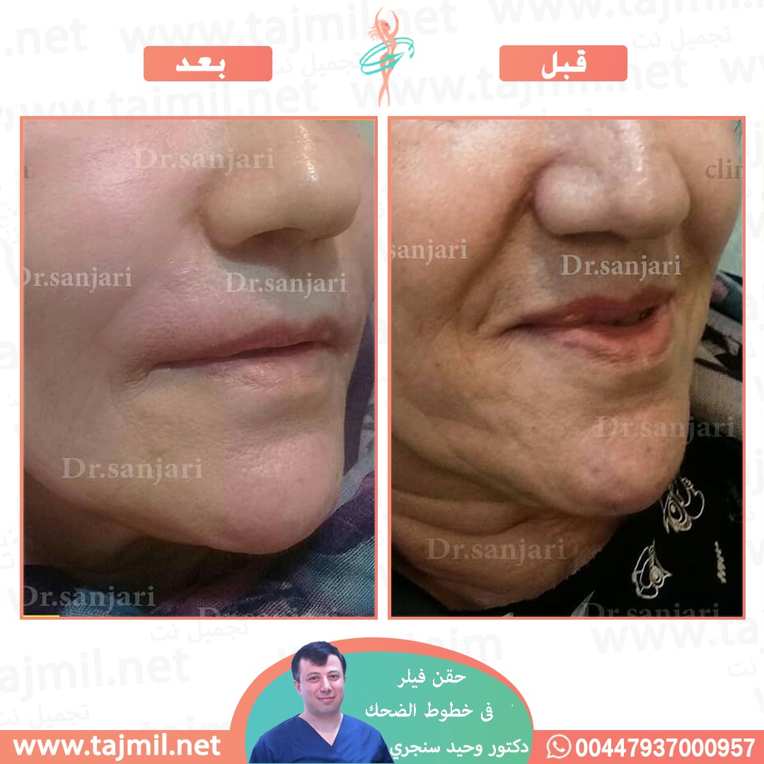  - دکتور وحید سنجري عملية حقن فیلر في لخطوط الضحک في ايران مع تجميل نت