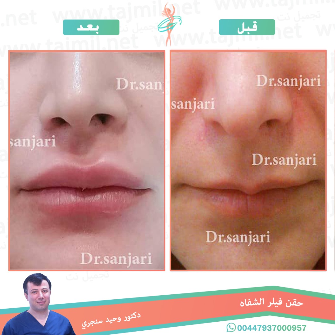  - دکتور وحید سنجري عملية حقن فیلر الشفاه في ايران مع تجميل نت