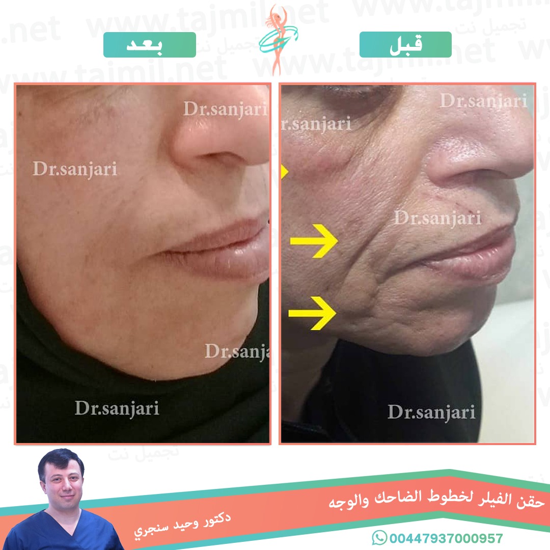  - دکتور وحید سنجري عملية حقن الفیلر لخطوط الضاحک والوجه في ايران مع تجميل نت