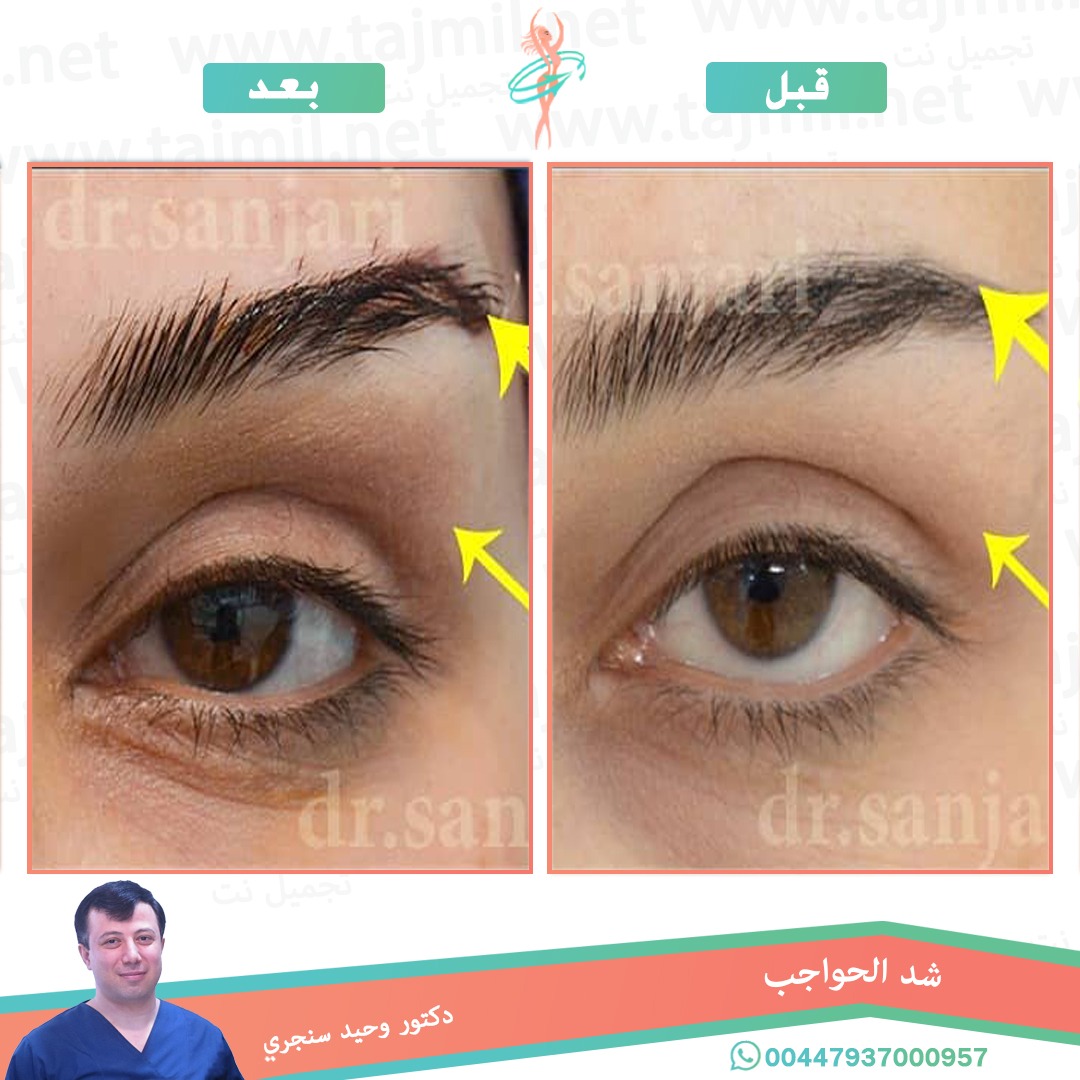  - دکتور وحید سنجري عملية شد الحواجب في ايران مع تجميل نت