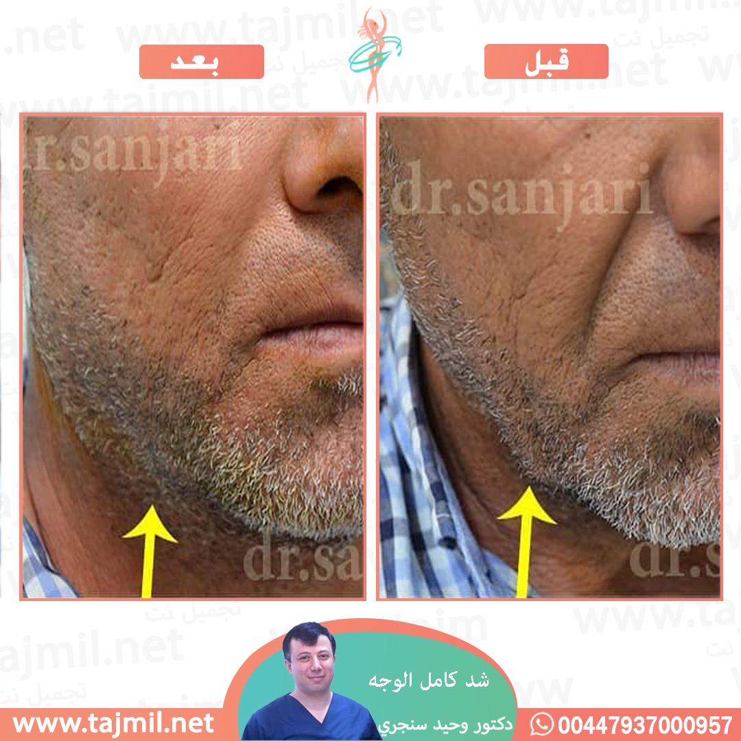  - دکتور وحید سنجري عملية شد کامل الوجه في ايران مع تجميل نت