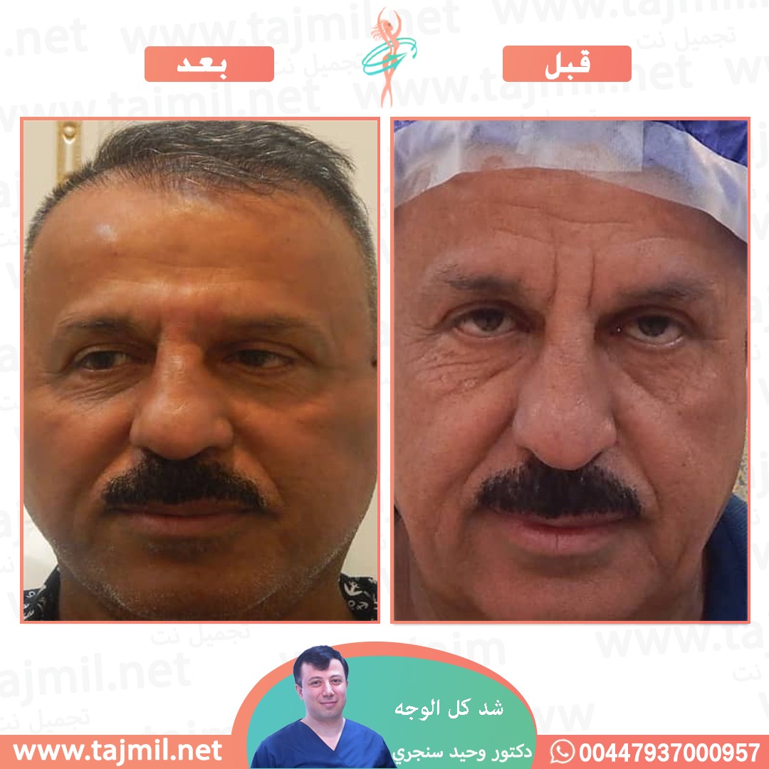  - دکتور وحید سنجري عملية زراعة العشر في ايران مع تجميل نت