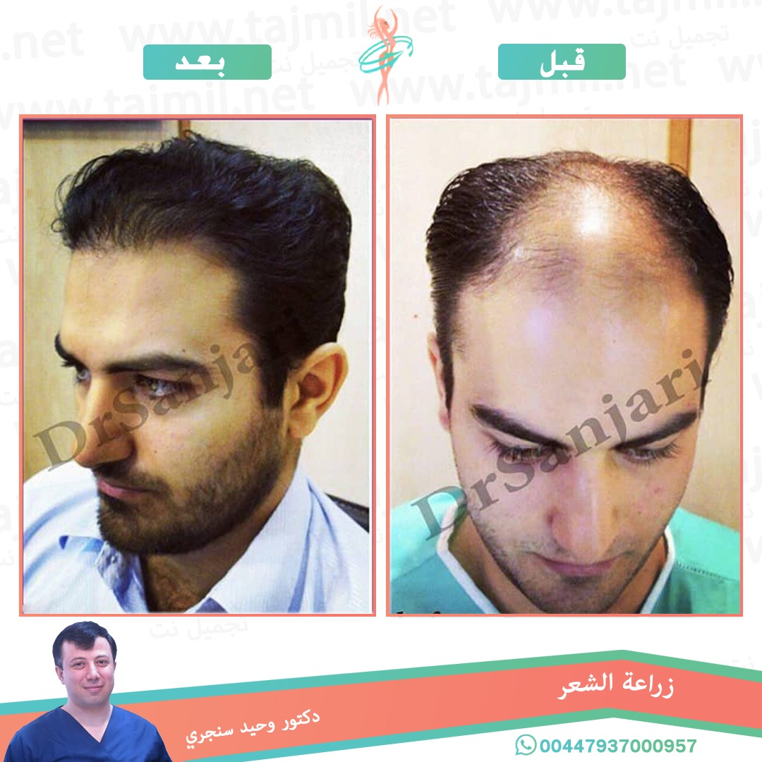  - دکتور وحید سنجري عملية زراعة العشر في ايران مع تجميل نت