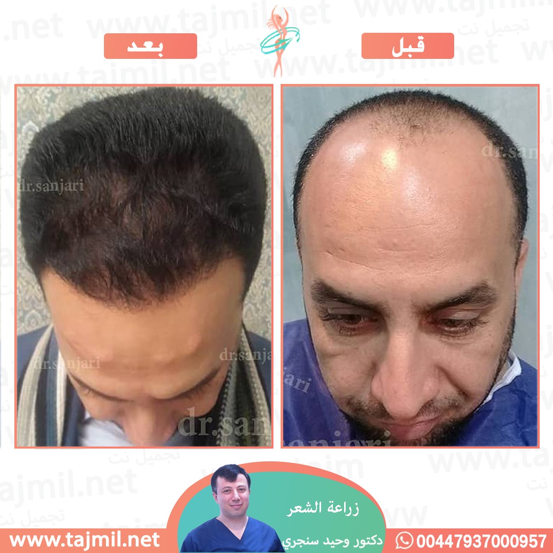  - دکتور وحید سنجري عملية زراعة العشر في ايران مع تجميل نت