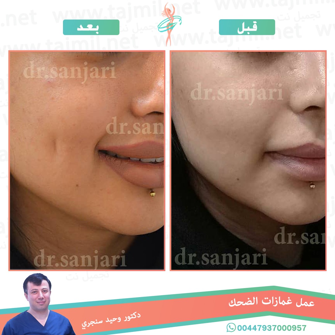  - دکتور وحید سنجري عملية غمازات الضحک في ايران مع تجميل نت