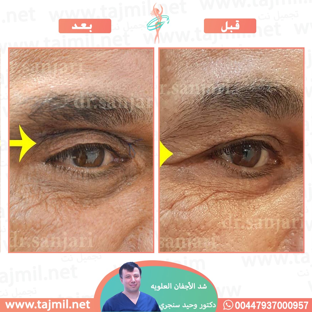  - دکتور وحید سنجري عملية شد الأجفان العویه في ايران مع تجميل نت