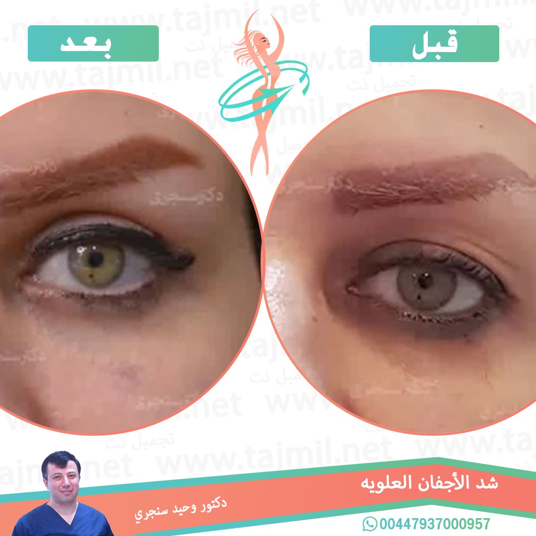  - دکتور وحید سنجري عملية شد الأجفان العویة في ايران مع تجميل نت