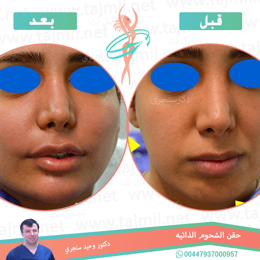  - دکتور وحید سنجري عملية حقن شحوم الذاتیه في ايران مع تجميل نت