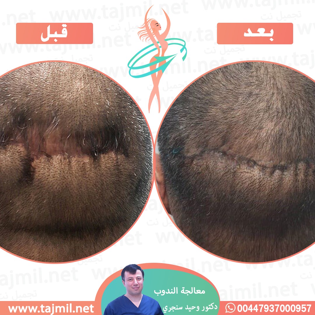  - دکتور وحید سنجري عملية معالجة الندوب في ايران مع تجميل نت