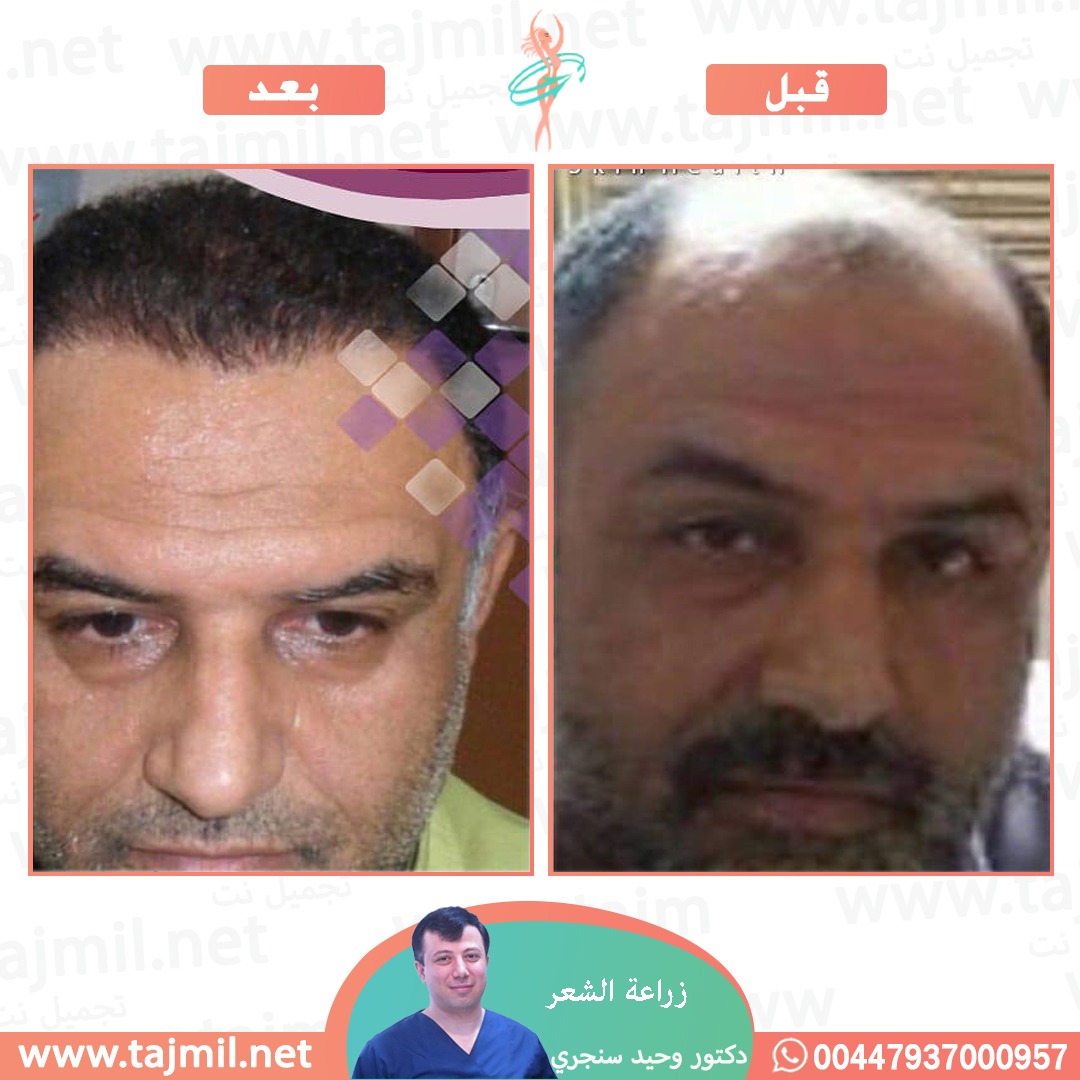  - دکتور وحید سنجري عملية زراعة العشر في ايران مع تجميل نت