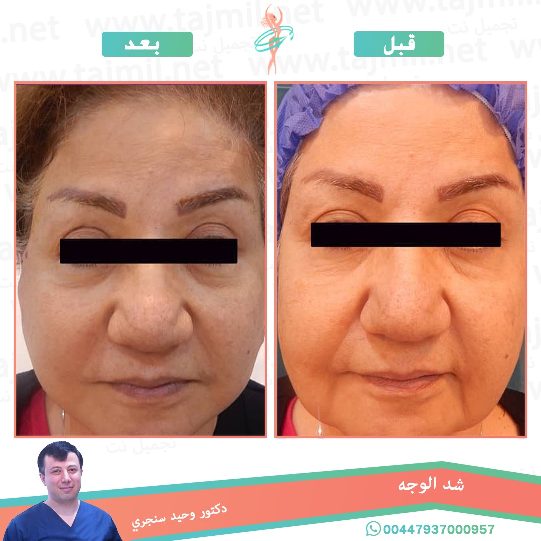  - دکتور وحید سنجري عملية شد الوجه في ايران مع تجميل نت