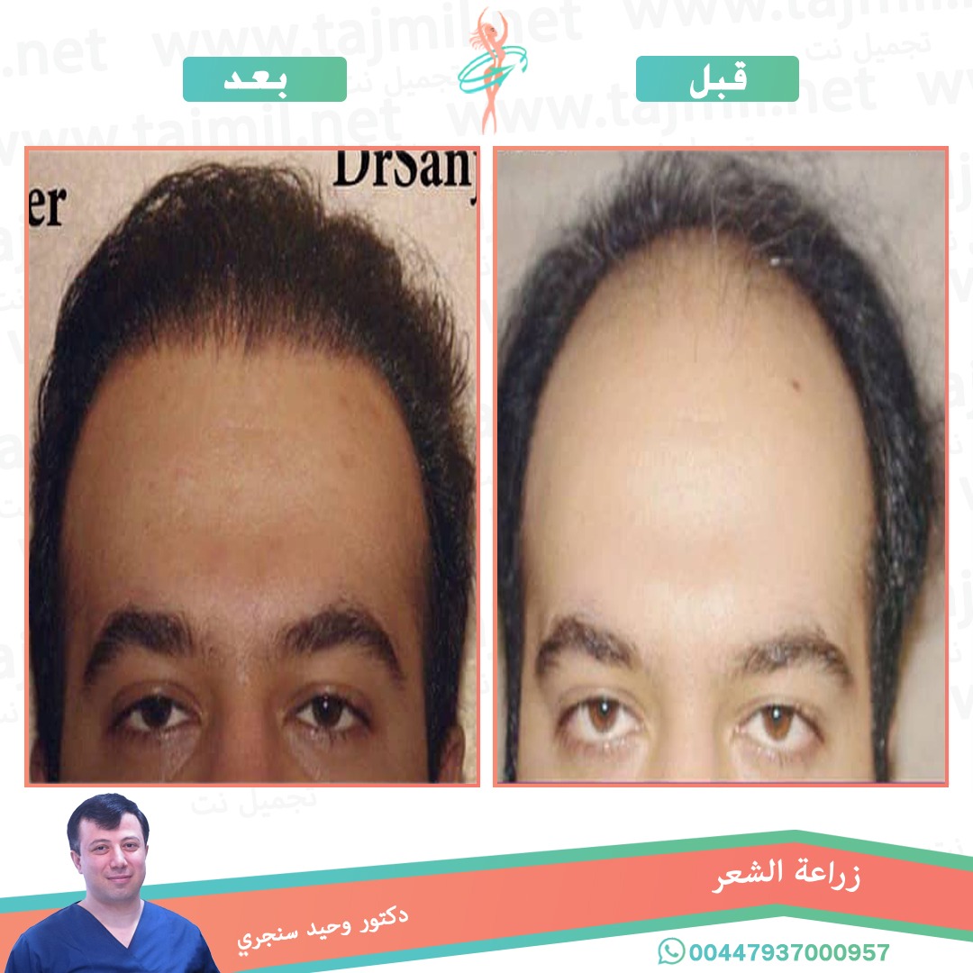  - دکتور وحید سنجري عملية زراعة العشر في ايران مع تجميل نت