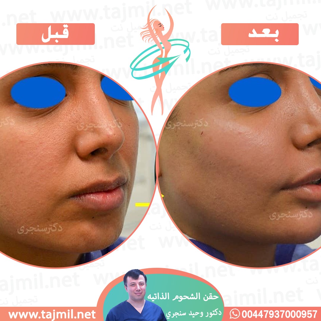  - دکتور وحید سنجري عملية حقن شحوم الذاتیه في ايران مع تجميل نت