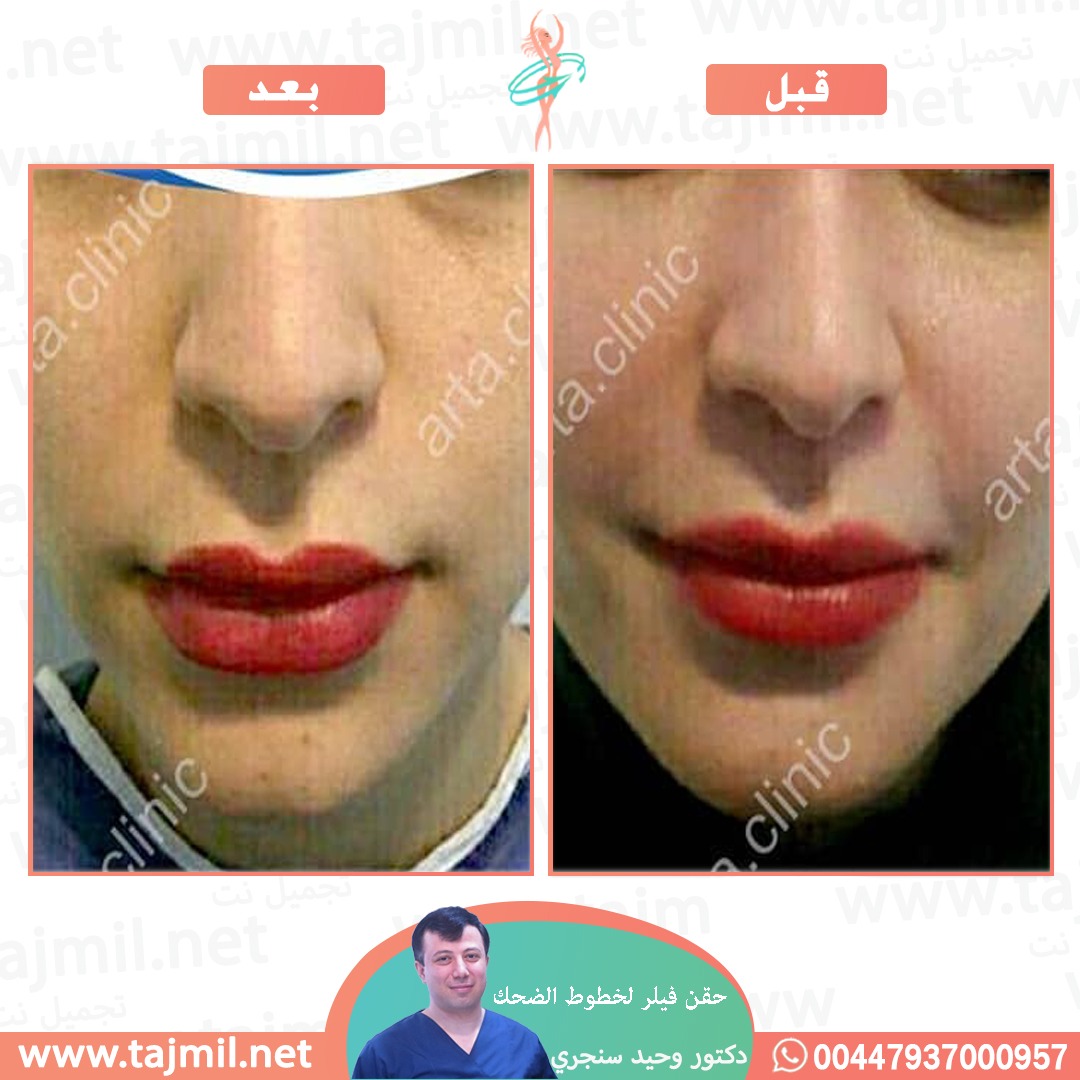  - دکتور وحید سنجري عملية حقن فیلر لخطوط الضحک في ايران مع تجميل نت