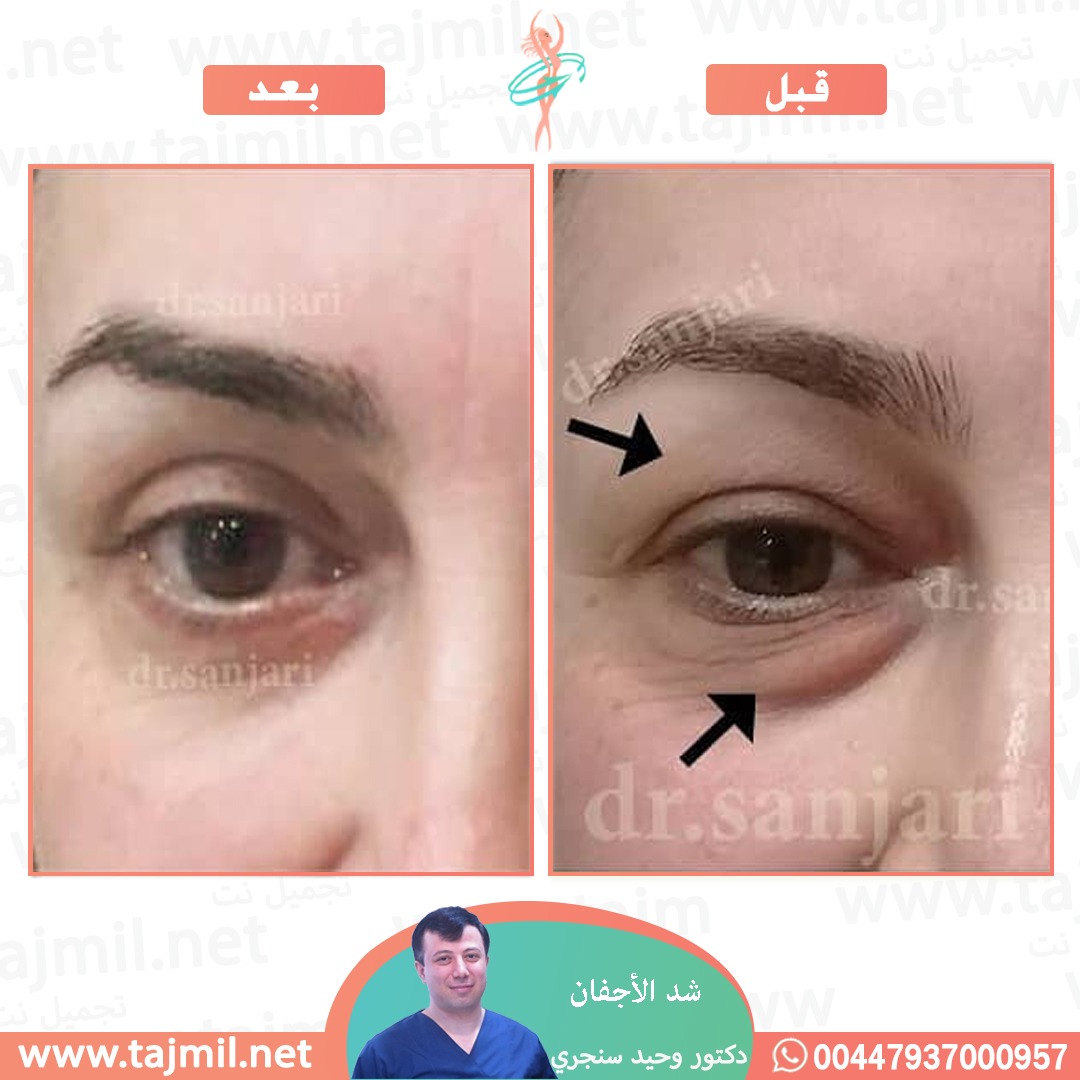  - دکتور وحید سنجري عملية شد الأجفان في ايران مع تجميل نت