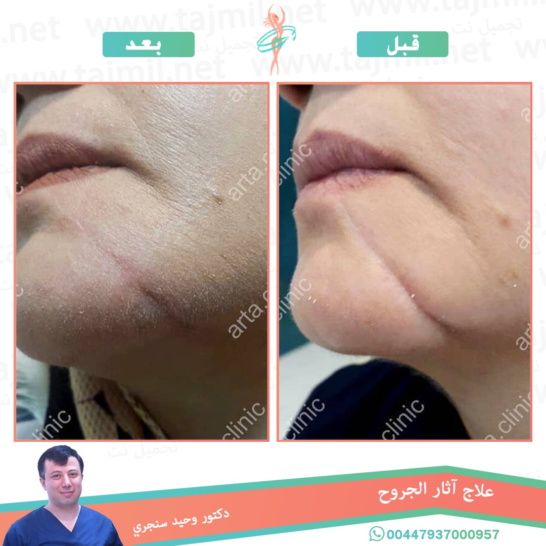  - دکتور وحید سنجري عملية علاج آثار الجروح في ايران مع تجميل نت