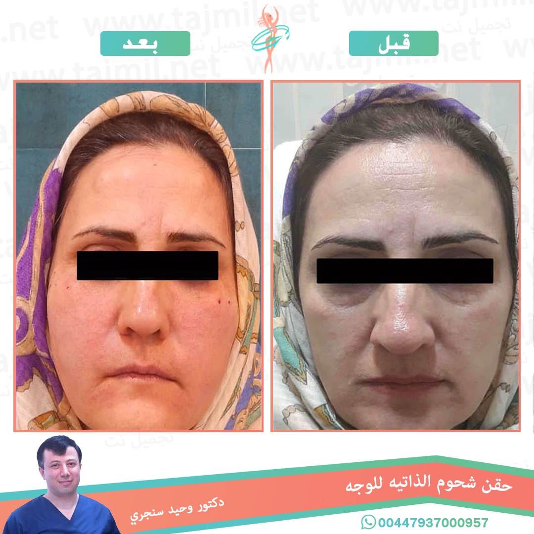  - دکتور وحید سنجري عملية حقن شحوم الذاتیه للوجه في ايران مع تجميل نت