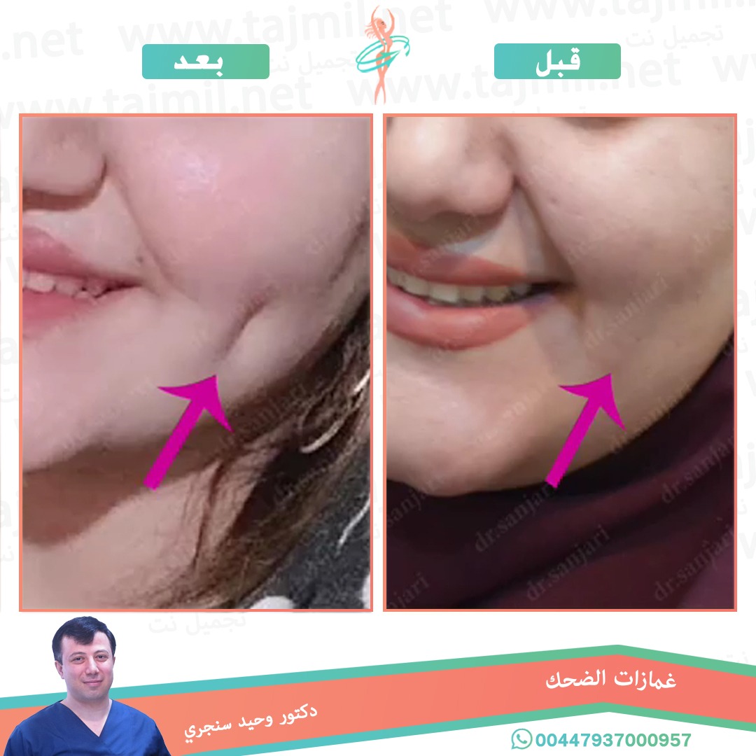  - دکتور وحید سنجري عملية غمازات الضحک في ايران مع تجميل نت